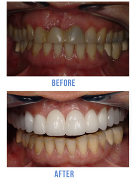 NYC Porcelain Veneers